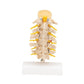 Stages of Disc Prolapse and Vertebral Degeneration