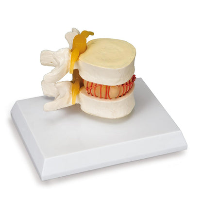 Herniated Disc Simulator