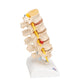 Stages of Disc Prolapse and Vertebral Degeneration