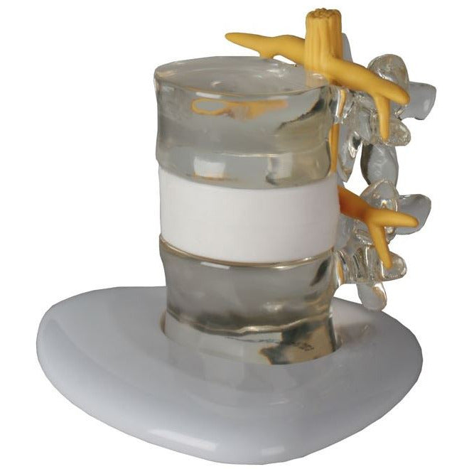 Erler Zimmer herniated disc simulator