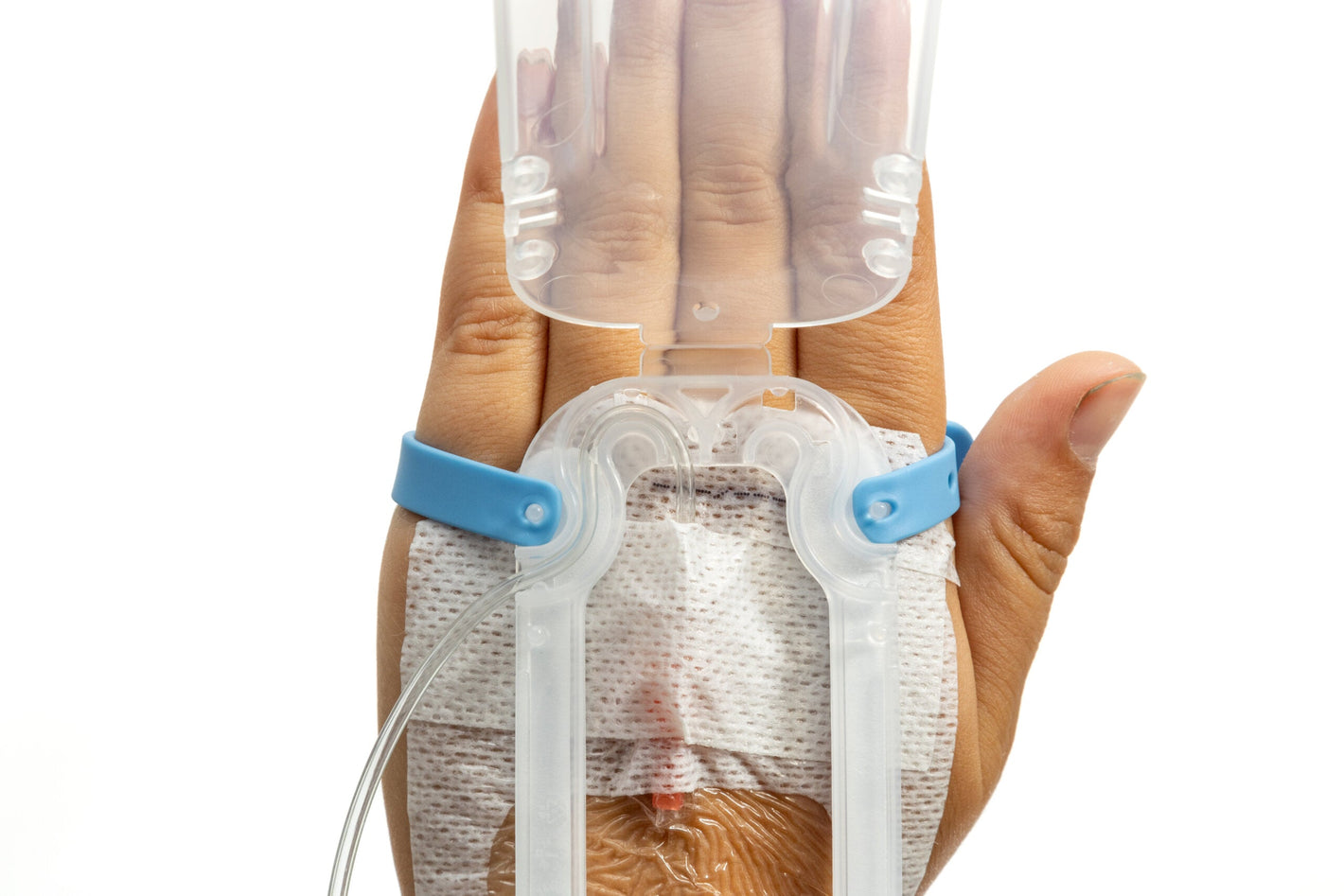 Pediatric IV Glove 3.0 securement device by IV Glove, pack of 25, secured around an IV catheter in a medical setting