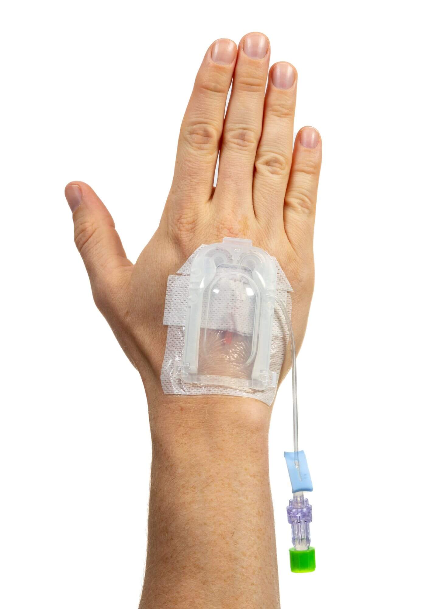 IV Glove 3.0 strapless IV securement device on open and closed hand, designed for secure catheter stabilization.
