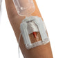 Close-up of IV Glove EasyStick IV securement device on arm, showing strapless stability and open design for secure IV placement.