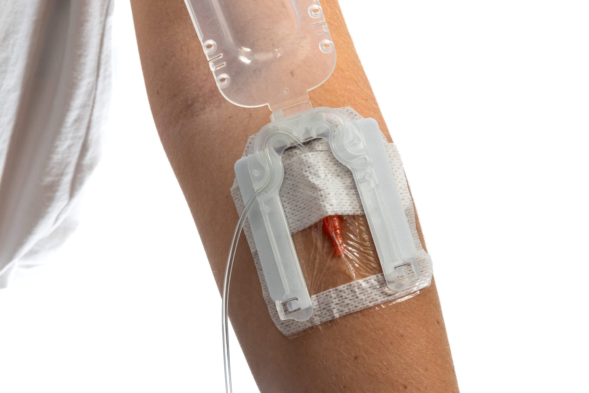 Close-up of IV Glove EasyStick IV securement device on arm, showing strapless stability and open design for secure IV placement.