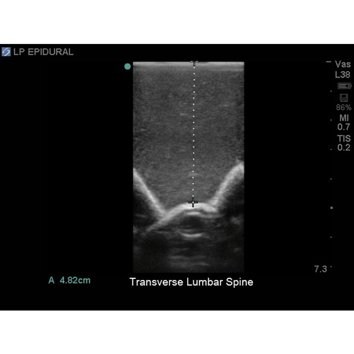 Blue Phantom spinal epidural model ultrasound image