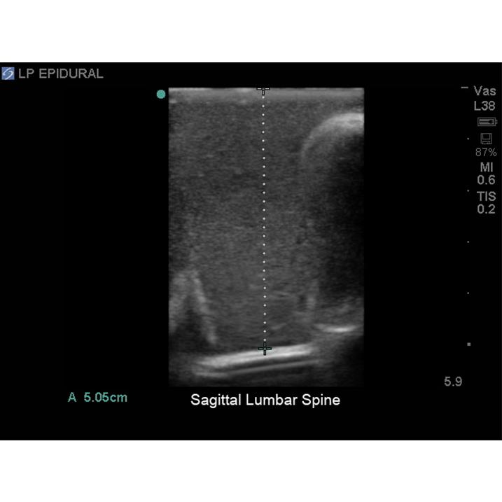 Blue Phantom spinal epidural model positioned for training