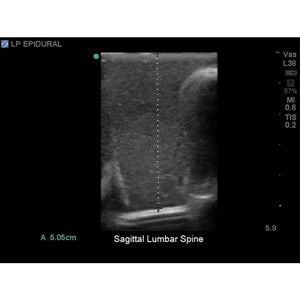 Blue Phantom spinal epidural model positioned for training
