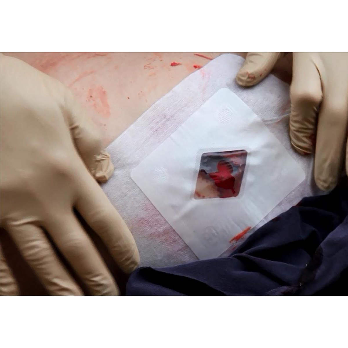 Russell Chest Seal (RCS) Vented Hydrogel Chest Wound Dressing
